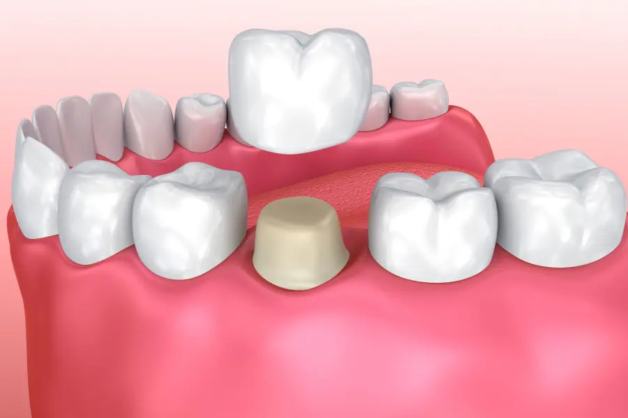 Dental Crowns in Egypt: Cost, Types, Safety, and What International Patients Should Expect
