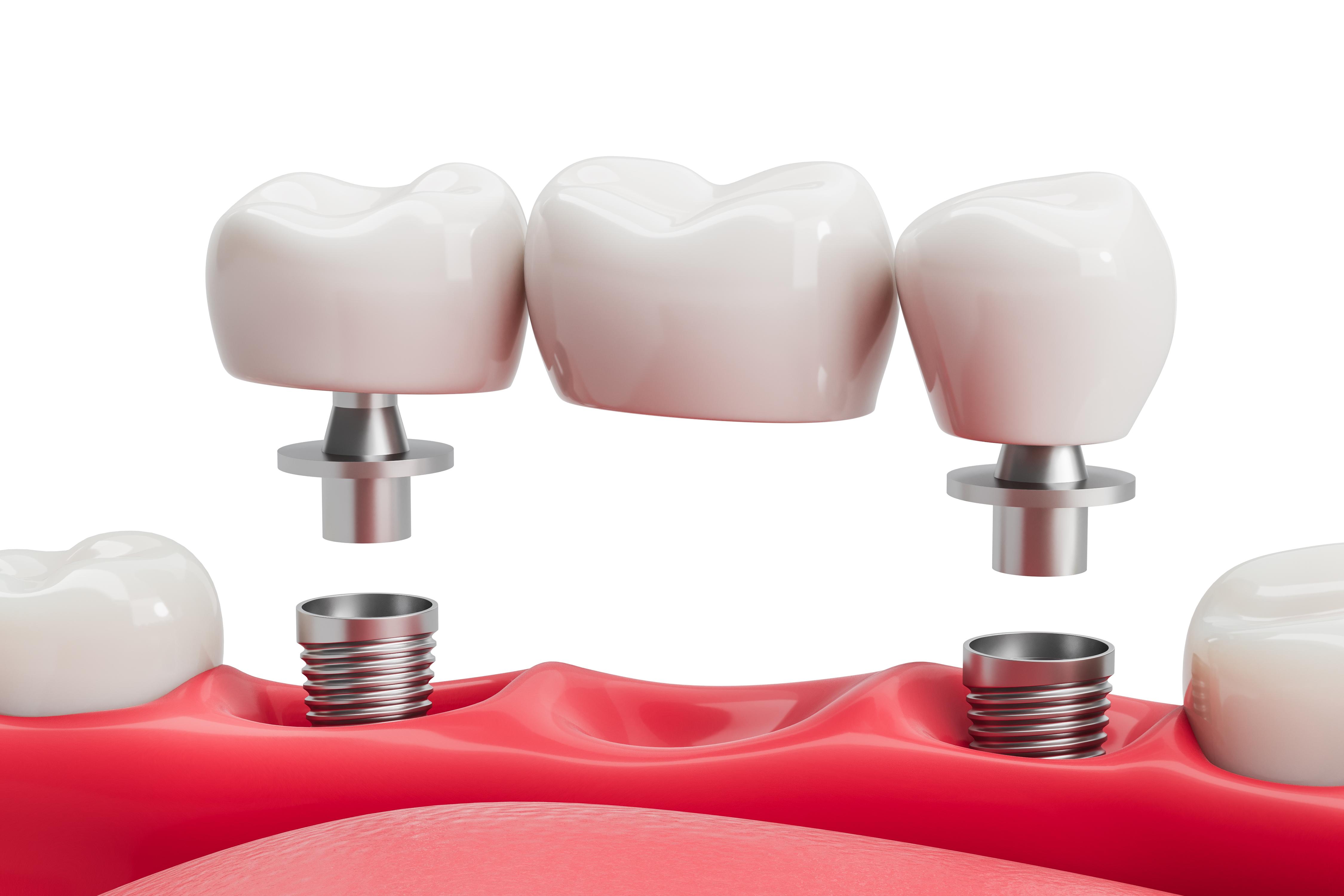 Dental Implant Brands Used in Egypt: Straumann, Nobel & What U.S. Patients Should Verify